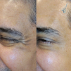 Dr. Daniel Sant' Ana - Botox em Bela Vista - Preenchimento Labial - Rinomodelao - Bioestimulador de Colgeno - Fios de PDO