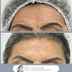Botox, Preenchimento Labial, Bioestimulador de Colgeno, Lavieen Dra Camila Bueno
