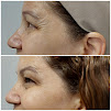 Clnica Solum Esttica Indianpolis SP, Ultraformer MPT e III, Laser Lavieen, Botox Facial, Preenchimento de Glteos e Facial