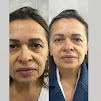 Clnica Esttica em SP / Dra Nayla Moura, Ultraformer, Limpeza de Pele, Lavieen, Botox Facial, Harmonizao Gltea em SP