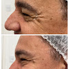 Esttica- Patrcia Oliveira - botox - Higienpolis - Jato de plasma- limpeza de pele, microagulhamento, peeling qumico,