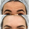 La Nou Higienpolis Clnica Esttica Dermatolgica, Ultraformer MPT, Lavieen, Botox, Harmonizao Gltea, Depilao a Laser